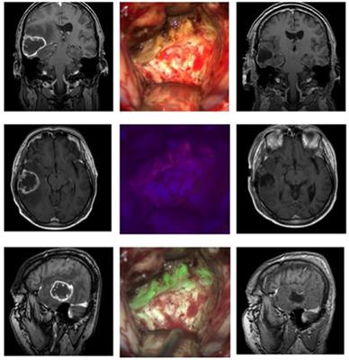 5-Aminolevulinic Acid Multispectral Imaging for the Fluorescence-Guided Resection of Brain Tumors: A Prospective Observational Study